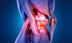 Diz osteoartritinde cerrahiye gerek kalmadan kalıcı rahatlama: 12 ayda ağrı yarı yarıya azaldı