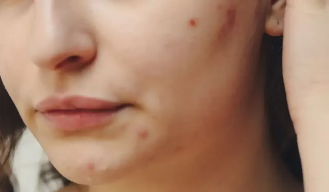 Yetişkin Sivilcesi Neden Bitmiyor? Hormonal, stres ve beslenme etkisi